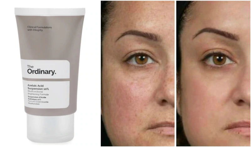 Azelaic Acid Suspension 10%