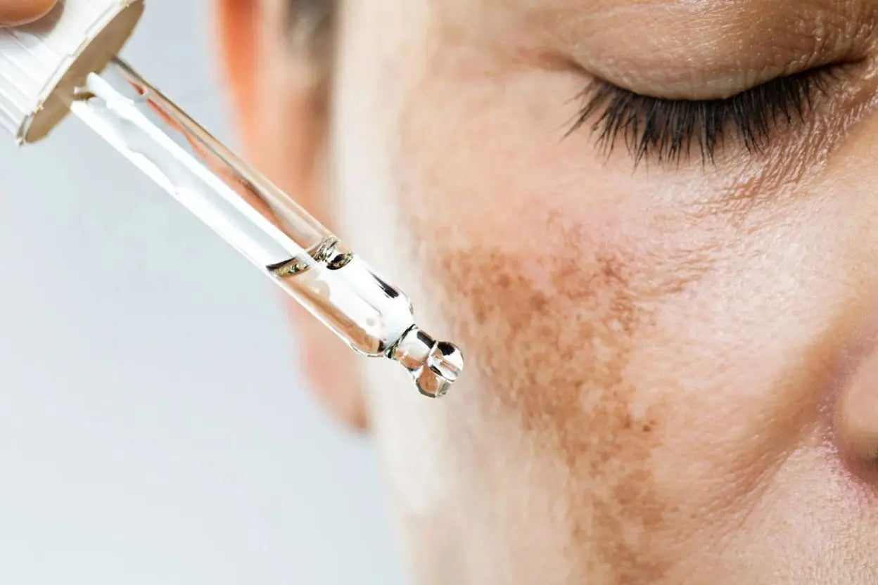 How to Deal with Hyperpigmentation Treatments and Skincare Tips.