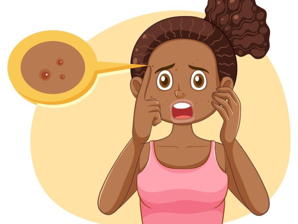 How to Manage Teenage Acne